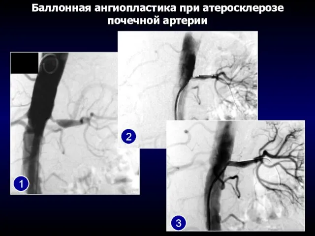 Баллонная ангиопластика при атеросклерозе почечной артерии 1 2 3