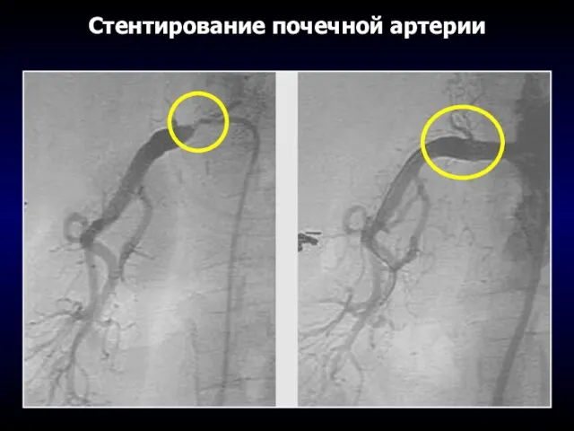 Стентирование почечной артерии