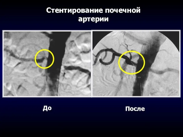 Стентирование почечной артерии До После