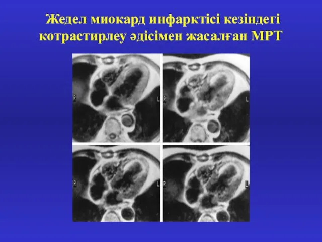 Жедел миокард инфарктісі кезіндегі котрастирлеу әдісімен жасалған МРТ