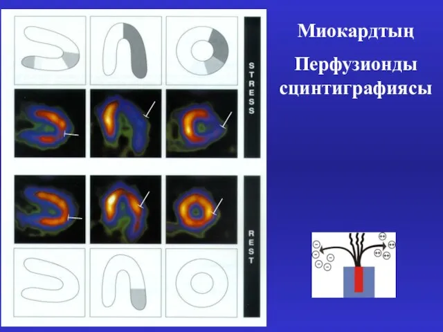 Миокардтың Перфузионды сцинтиграфиясы