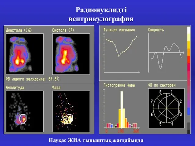 Радионуклидті вентрикулография Науқас ЖИА тыныштық жағдайында
