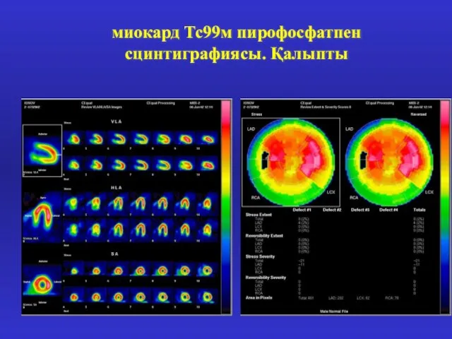 миокард Тс99м пирофосфатпен сцинтиграфиясы. Қалыпты