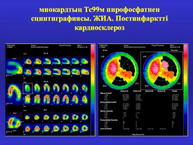 миокардтың Тс99м пирофосфатпен сцинтиграфиясы. ЖИА. Постинфарктті кардиосклероз