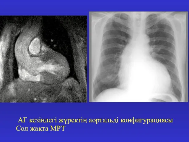 АГ кезіндегі жүректің аортальді конфигурациясы Сол жақта МРТ