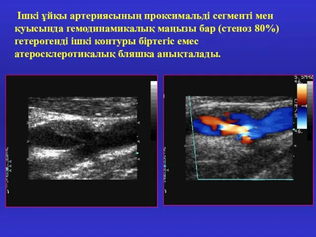 Ішкі ұйқы артериясының проксимальді сегменті мен қуысында гемодинамикалық маңызы бар (стеноз 80%)