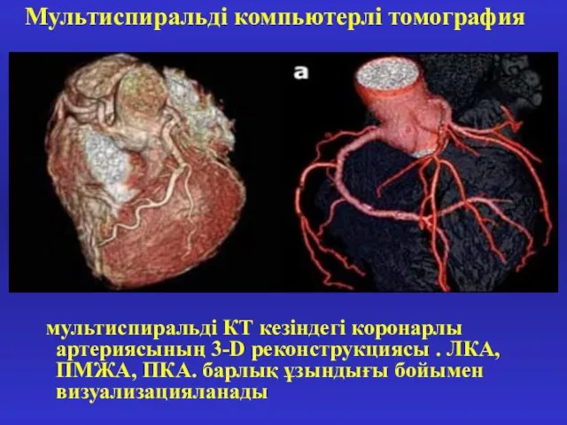 мультиспиральді КТ кезіндегі коронарлы артериясының 3-D реконструкциясы . ЛКА, ПМЖА, ПКА. барлық