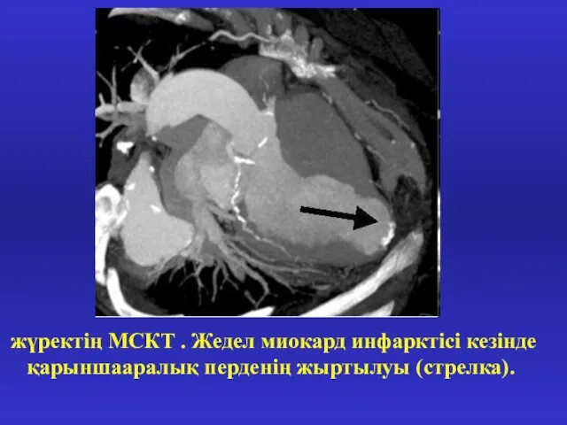 жүректің МСКТ . Жедел миокард инфарктісі кезінде қарыншааралық перденің жыртылуы (стрелка).