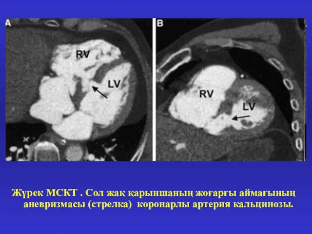 Жүрек МСКТ . Сол жақ қарыншаның жоғарғы аймағының аневризмасы (стрелка) коронарлы артерия кальцинозы.