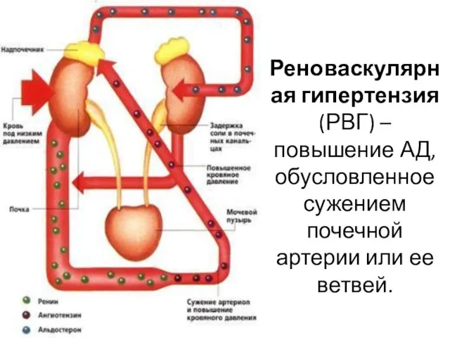 Реноваскулярная гипертензия (РВГ) – повышение АД, обусловленное сужением почечной артерии или ее ветвей.