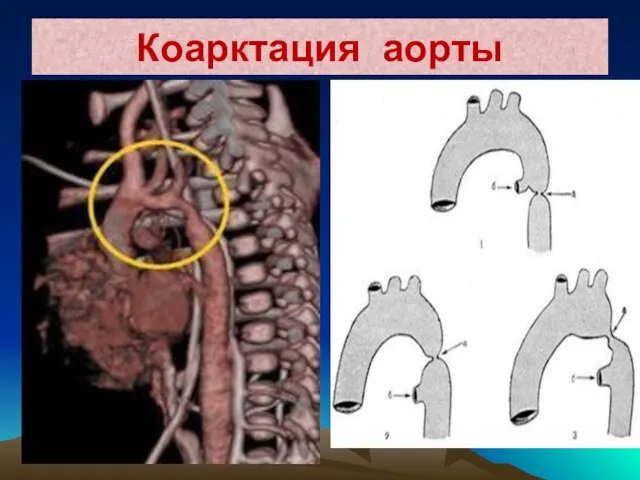 Коарктация аорты