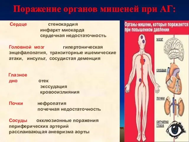 Поражение органов мишеней при АГ: Сердце стенокардия инфаркт миокарда сердечная недостаточность Головной