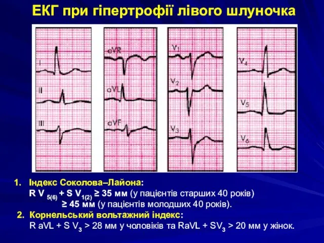 ЕКГ при гіпертрофії лівого шлуночка Індекс Соколова–Лайона: R V 5(6) + S