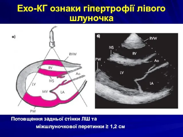 Ехо-КГ ознаки гіпертрофії лівого шлуночка Потовщення задньої стінки ЛШ та міжшлуночкової перетинки ≥ 1,2 см