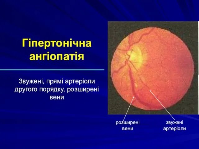 Гіпертонічна ангіопатія Звужені, прямі артеріоли другого порядку, розширені вени розширені вени звужені артеріоли