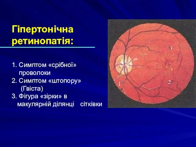 Гіпертонічна ретинопатія: 1. Симптом «срібної» проволоки 2. Симптом «штопору» (Гвіста) 3. Фігура