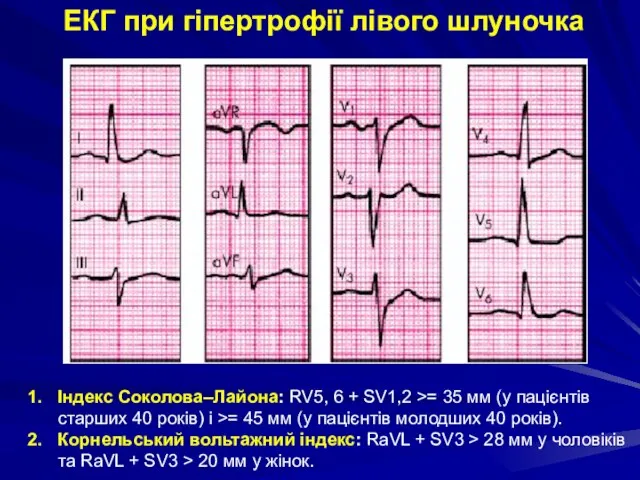 ЕКГ при гіпертрофії лівого шлуночка Індекс Соколова–Лайона: RV5, 6 + SV1,2 >=