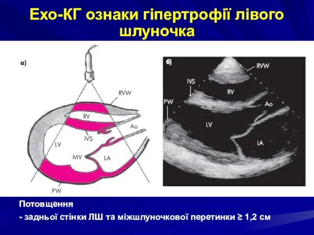 Ехо-КГ ознаки гіпертрофії лівого шлуночка Потовщення - задньої стінки ЛШ та міжшлуночкової перетинки ≥ 1,2 см