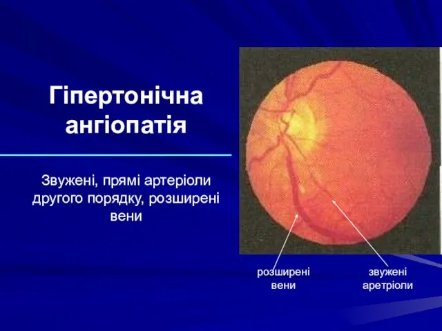 Гіпертонічна ангіопатія Звужені, прямі артеріоли другого порядку, розширені вени розширені вени звужені аретріоли