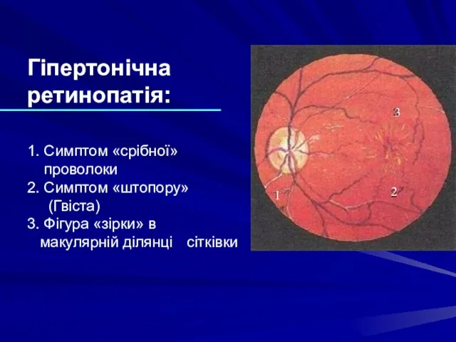 Гіпертонічна ретинопатія: 1. Симптом «срібної» проволоки 2. Симптом «штопору» (Гвіста) 3. Фігура