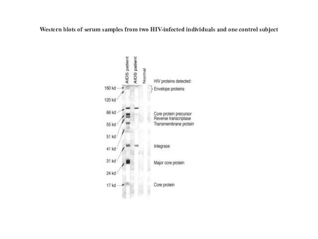 Western blots of serum samples from two HIV-infected individuals and one control subject