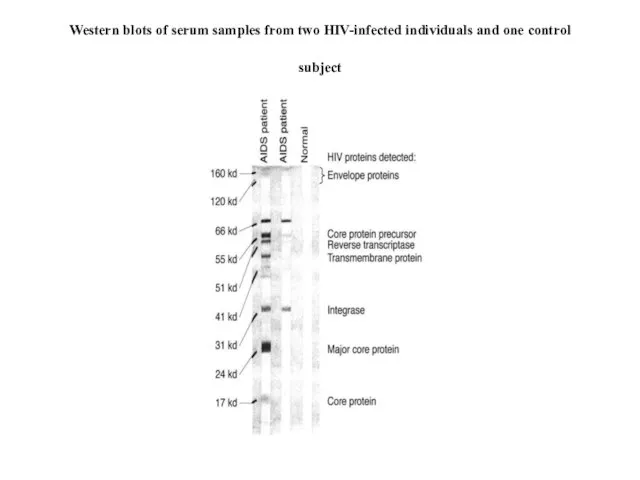 Western blots of serum samples from two HIV-infected individuals and one control subject