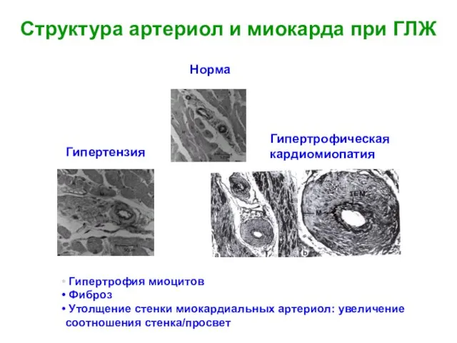 Структура артериол и миокарда при ГЛЖ Норма Гипертензия Гипертрофическая кардиомиопатия Гипертрофия миоцитов