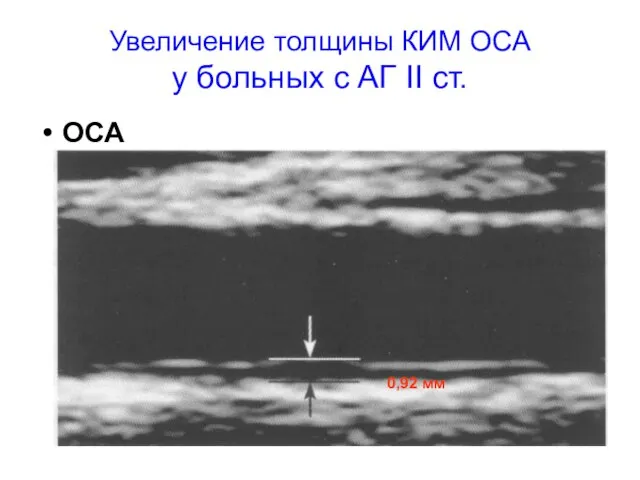 Увеличение толщины КИМ ОСА у больных с АГ II ст. ОСА 0,92 мм