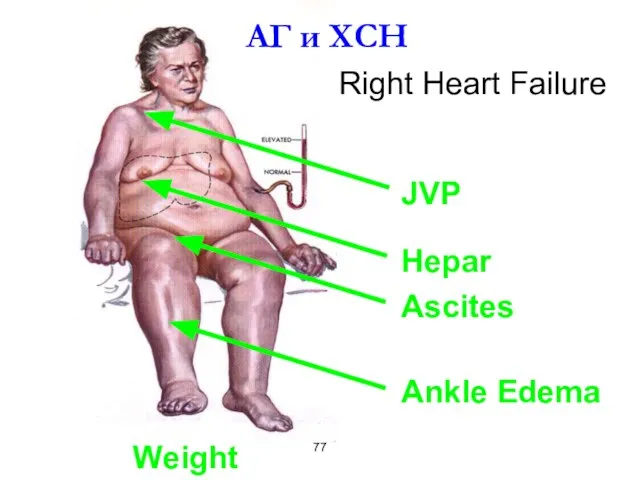 Right Heart Failure Weight АГ и ХСН