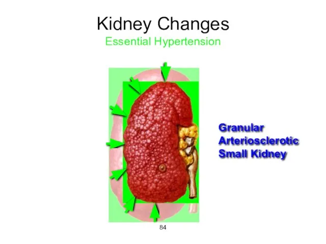 Kidney Changes Essential Hypertension