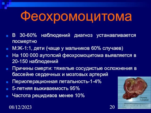 08/12/2023 Феохромоцитома В 30-60% наблюдений диагноз устанавливается посмертно М:Ж-1:1, дети (чаще у