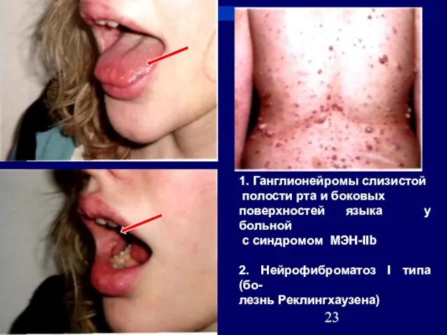 08/12/2023 1. Ганглионейромы слизистой полости рта и боковых поверхностей языка у больной