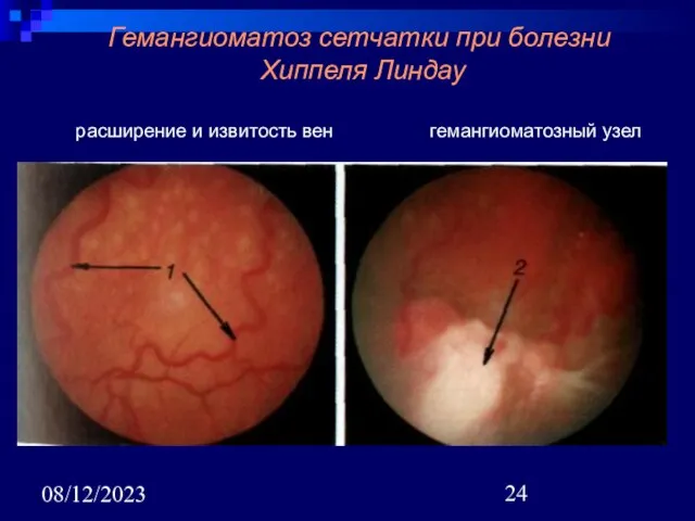 08/12/2023 Гемангиоматоз сетчатки при болезни Хиппеля Линдау расширение и извитость вен гемангиоматозный узел