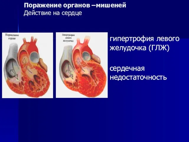 Поражение органов –мишеней Действие на сердце гипертрофия левого желудочка (ГЛЖ) сердечная недостаточность