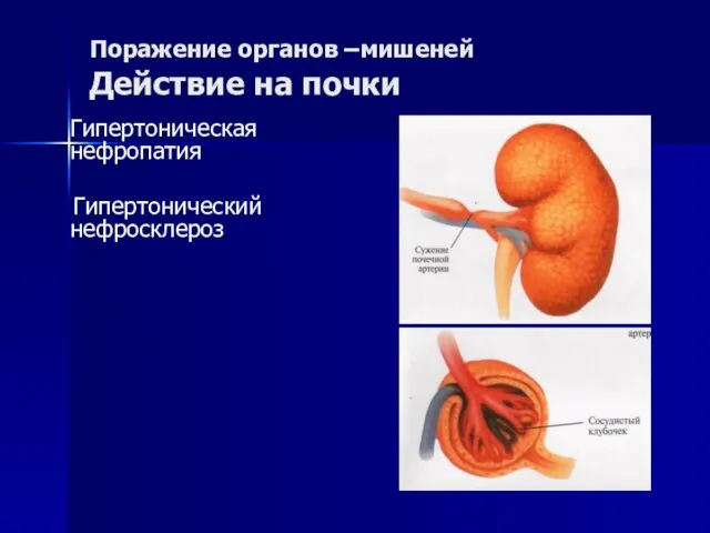 Поражение органов –мишеней Действие на почки Гипертоническая нефропатия Гипертонический нефросклероз