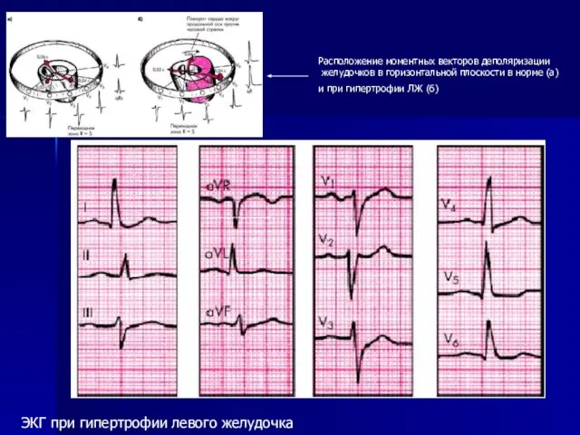 Расположение моментных векторов деполяризации желудочков в горизонтальной плоскости в норме (а) и