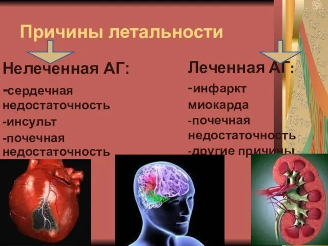 Причины летальности Нелеченная АГ: -сердечная недостаточность -инсульт -почечная недостаточность Леченная АГ: -инфаркт