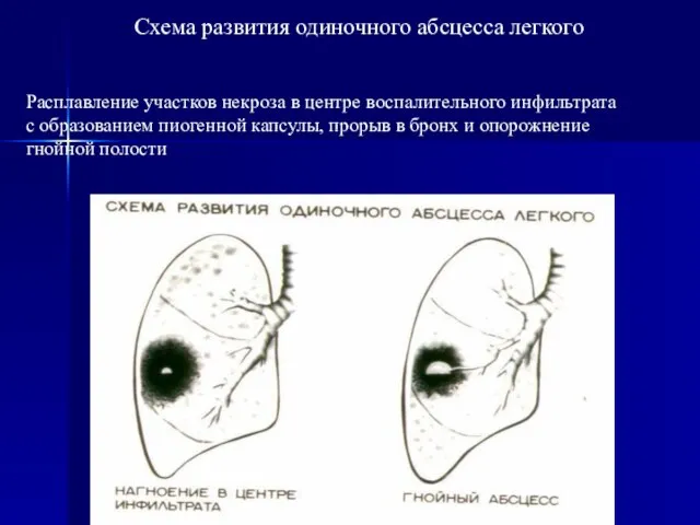 Схема развития одиночного абсцесса легкого Расплавление участков некроза в центре воспалительного инфильтрата