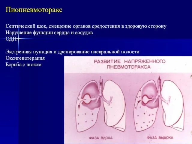 Пиопневмоторакс Септический шок, смещение органов средостения в здоровую сторону Нарушение функции сердца