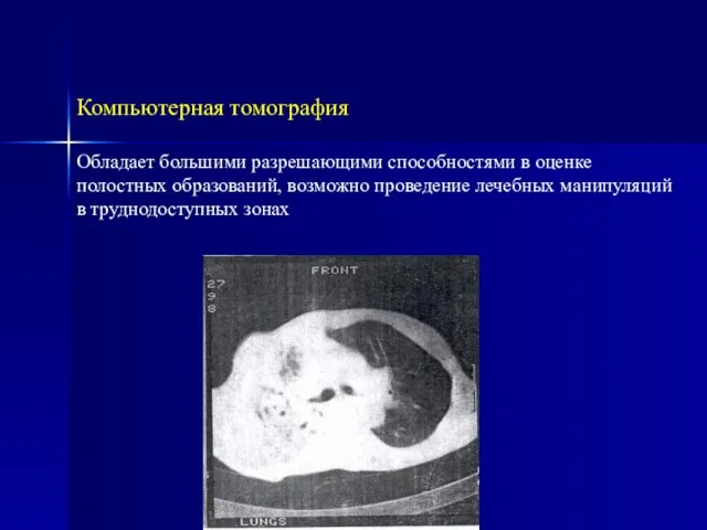 Компьютерная томография Обладает большими разрешающими способностями в оценке полостных образований, возможно проведение