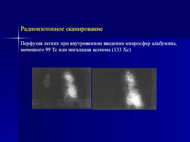 Радиоизотопное сканирование Перфузия легких при внутривенном введении микросфер альбумина, меченного 99 Тс