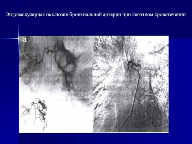 Эндоваскулярная окклюзия бронхиальной артерии при легочном кровотечении