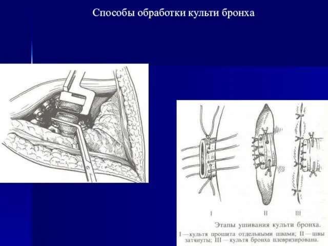 Способы обработки культи бронха