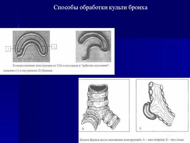 Способы обработки культи бронха