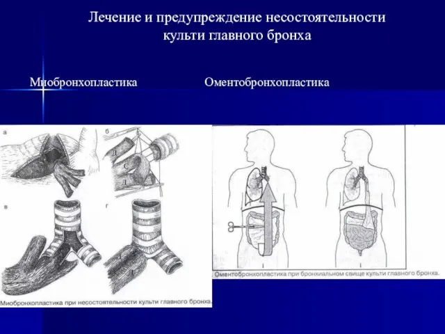 Лечение и предупреждение несостоятельности культи главного бронха Миобронхопластика Оментобронхопластика