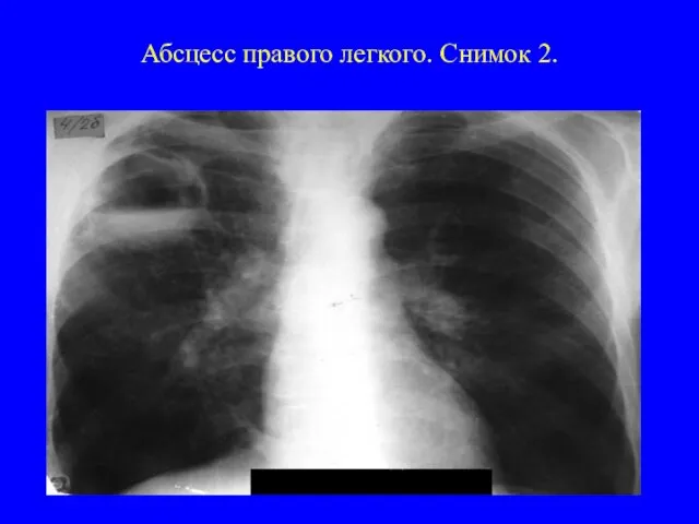 Абсцесс правого легкого. Снимок 2.