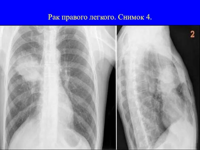Рак правого легкого. Снимок 4.