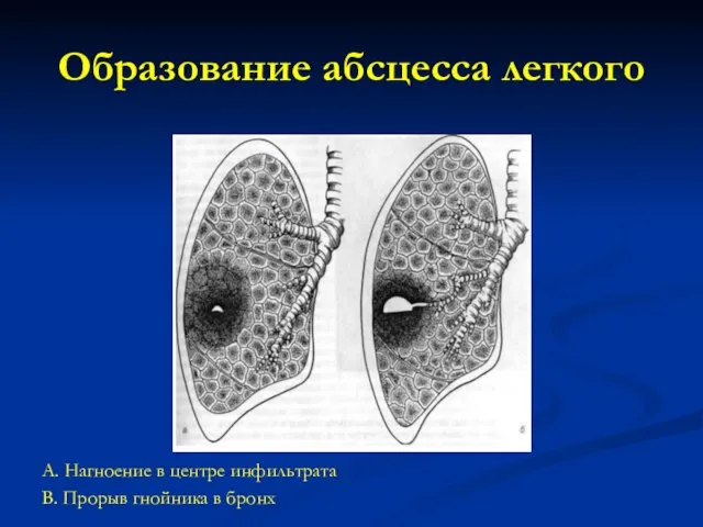 Образование абсцесса легкого А. Нагноение в центре инфильтрата В. Прорыв гнойника в бронх