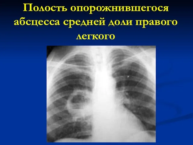 Полость опорожнившегося абсцесса средней доли правого легкого