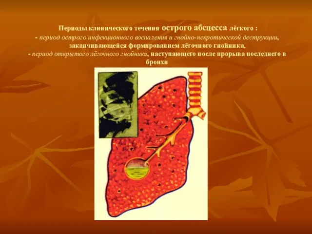 Периоды клинического течения острого абсцесса лёгкого : - период острого инфекционного воспаления